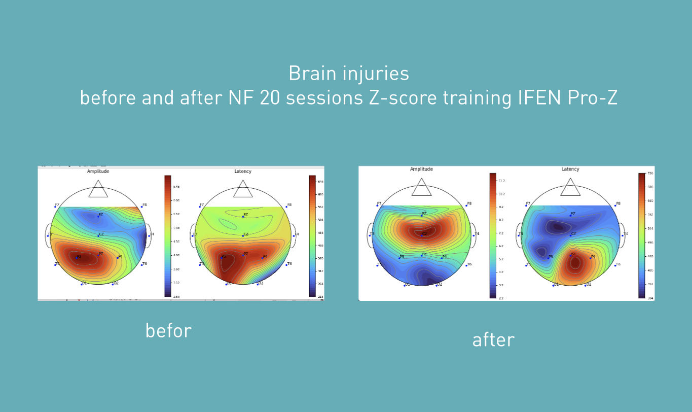 Brainmaps of brain injuries before and after NF 20 sessions Z-score training IFEN Pro-Z